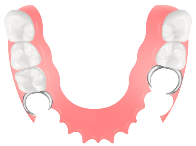 部分入れ歯（コンフォート）