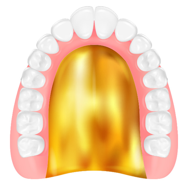 総入れ歯（金属床義歯）