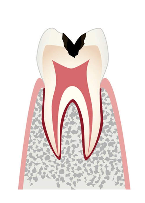 C2歯の内部まで進行した虫歯