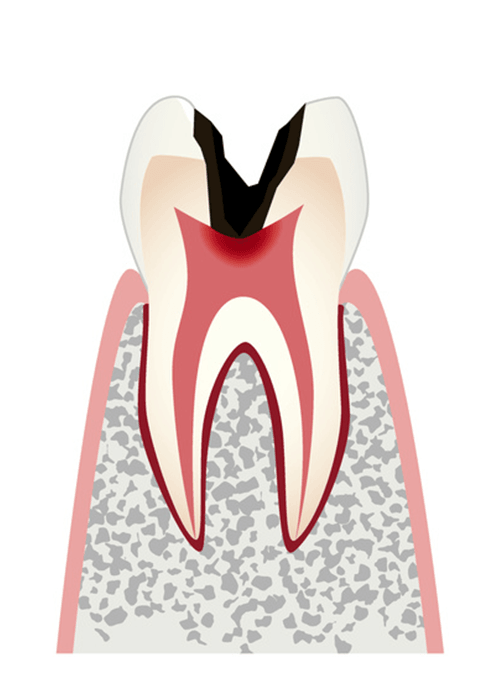 C3神経まで進行した虫歯