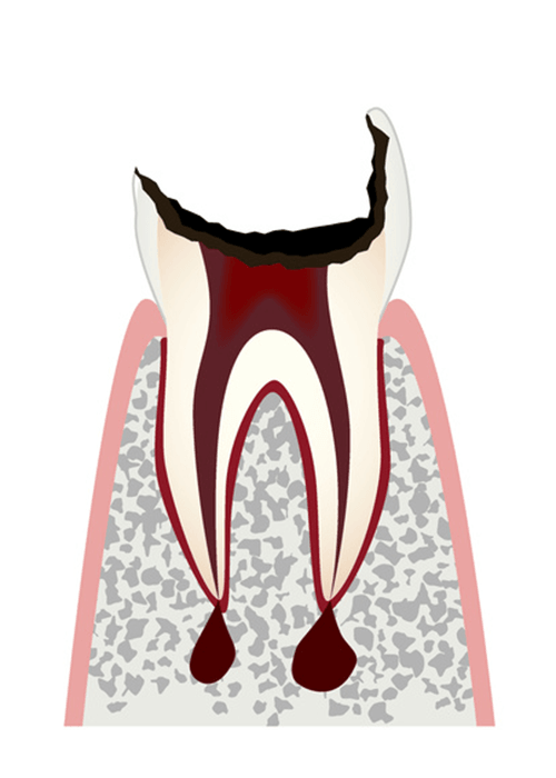 C4歯の根まで進行した虫歯